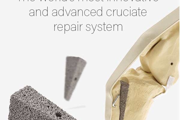 Tibial Tuberosity Advancement (TTA)